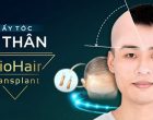 Cấy tóc tự thân
