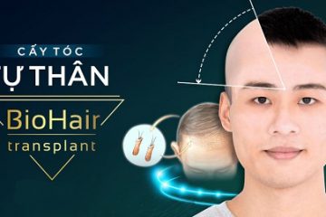 Cấy tóc tự thân