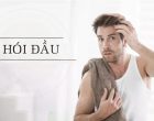 Hói đầu có chữa được không