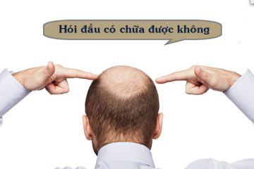 Hói đầu có chữa được không