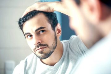 Hói đầu tuổi 20