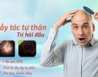 Trị hói đầu ở nam giới