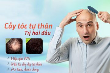 Trị hói đầu ở nam giới