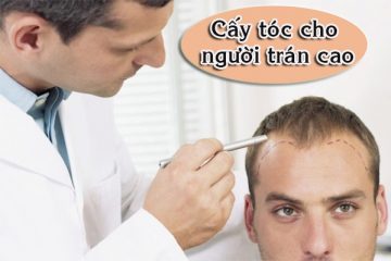 Cấy tóc cho người trán cao