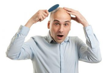 Cách chữa trị hói đầu ở nam giới