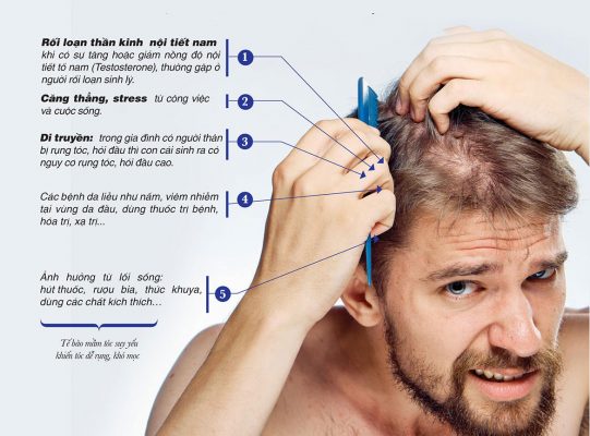 Cách chữa trị hói đầu ở nam giới