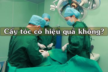 Cấy tóc có hiệu quả không