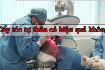 Cấy tóc tự thân có hiệu quả không