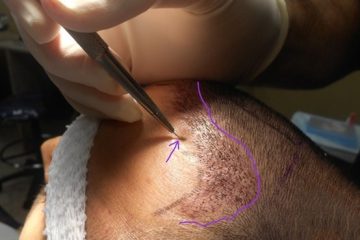 Cấy tóc sinh học giá bao nhiêu