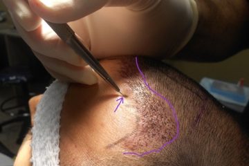 cấy tóc có nguy hiểm không