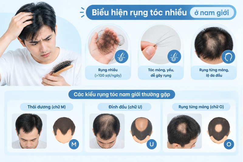 biểu hiện rụng tóc nhiêu ở nam giới