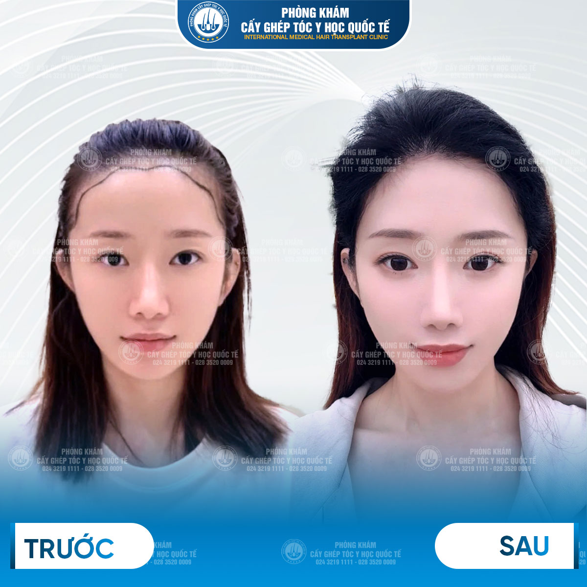 rụng tóc