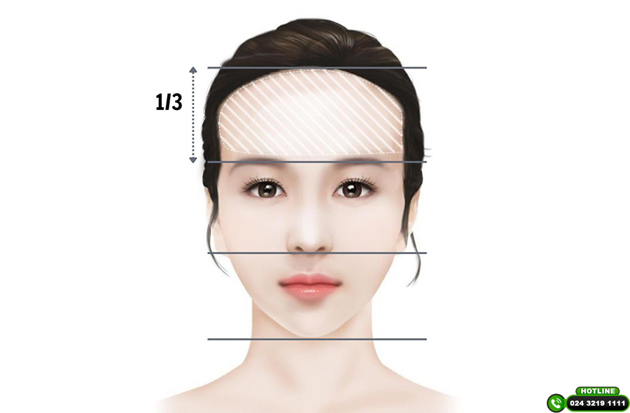 cấy đường chân tóc trán
