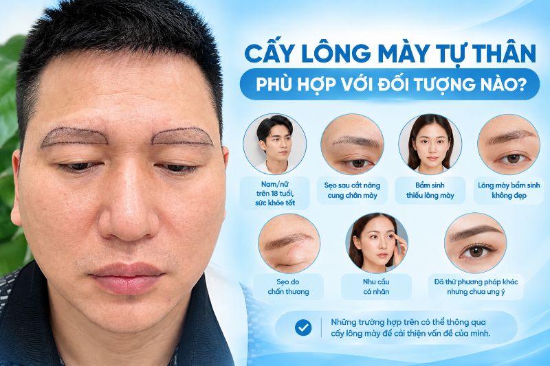 cấy lông mày tự thân phù hợp với đối tượng nào