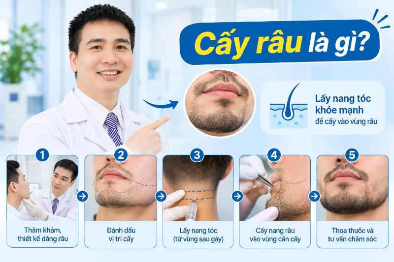 cấy râu là gì 