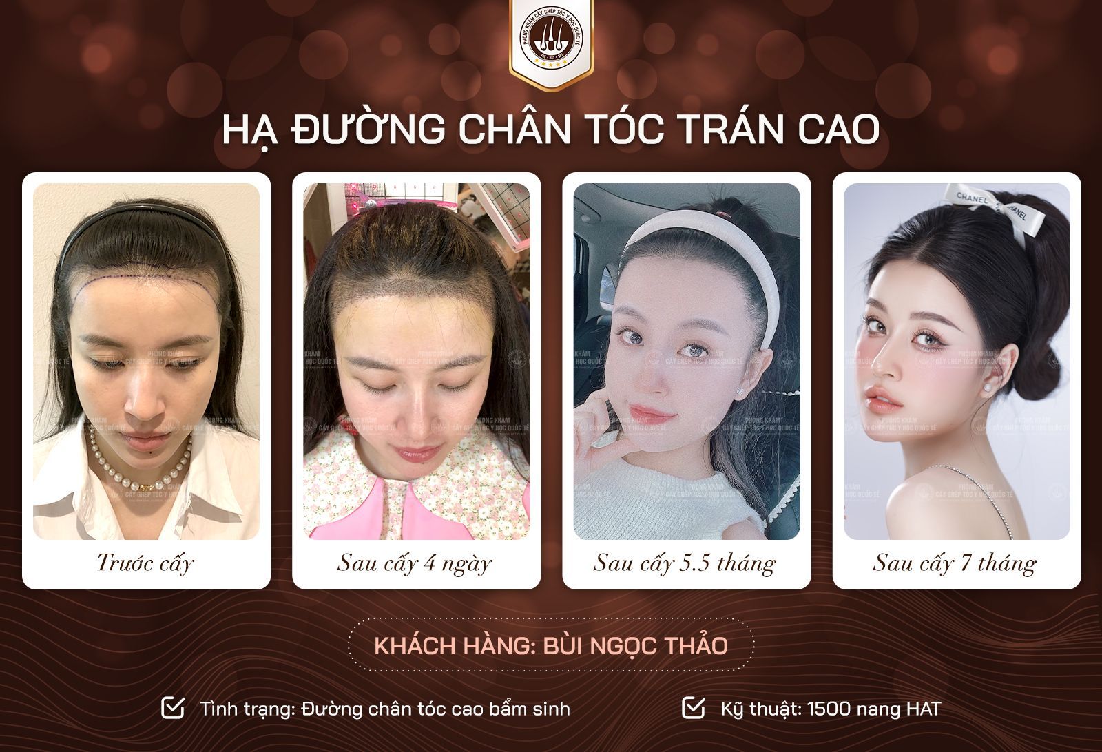 kết quả sau cấy