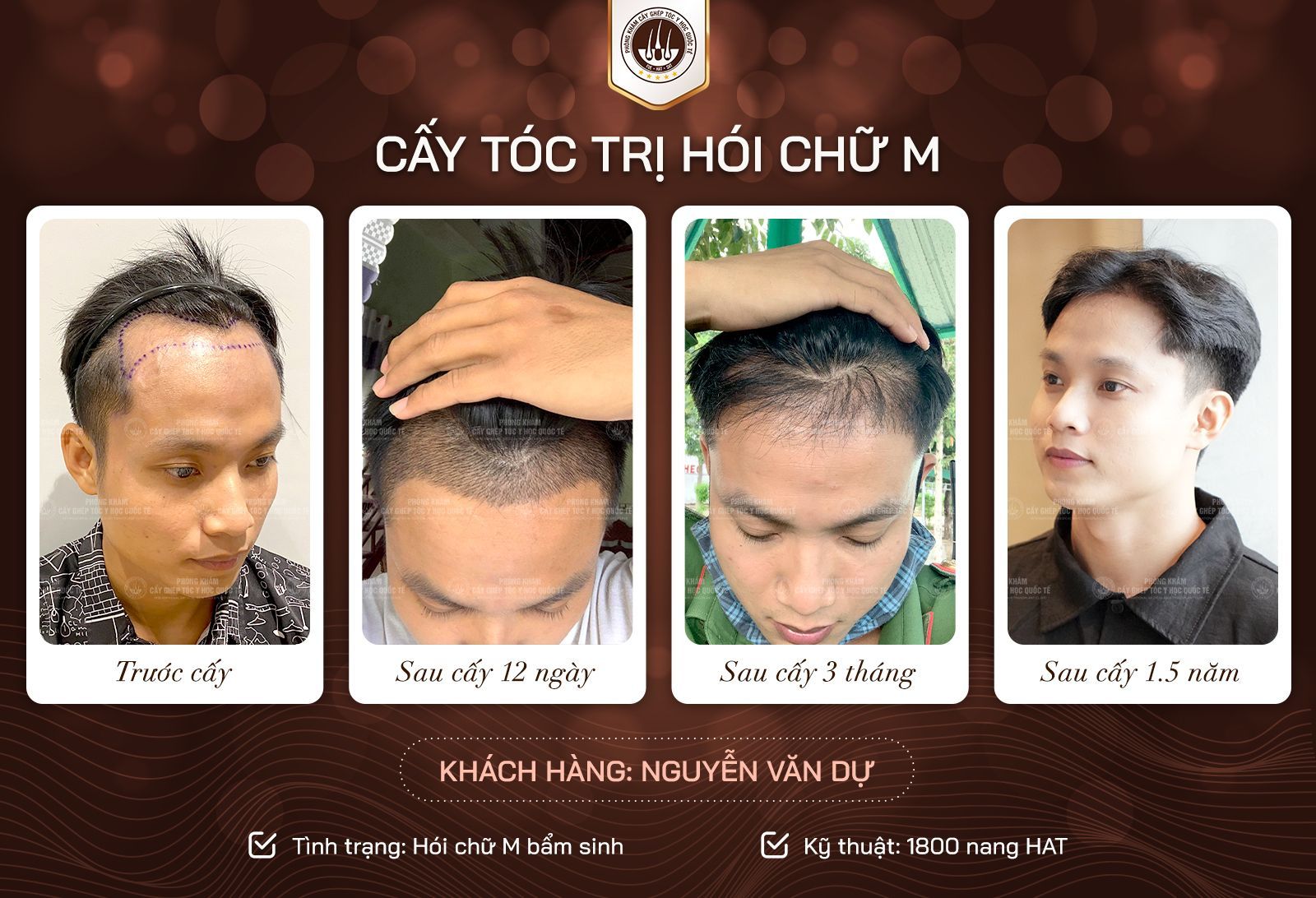 cấy tóc trị hói chữ m