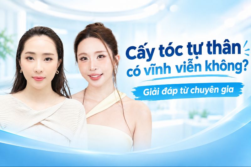 cấy tóc tự thân có được vĩnh vieẽn không