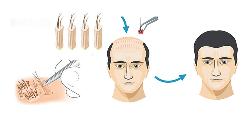 cấy tóc tự thân là gì