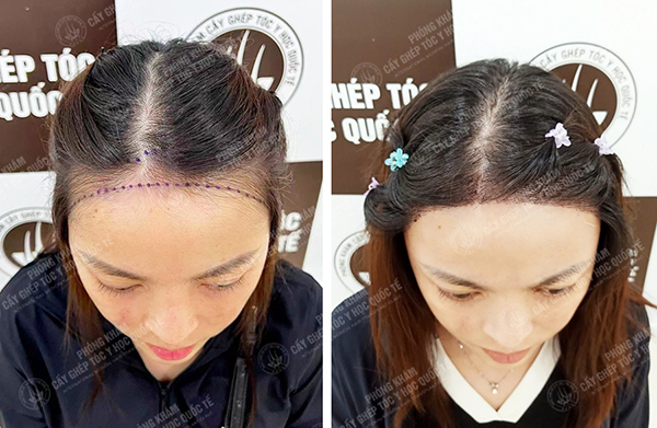 khách hàng được bác sĩ Thọ thực hiện
