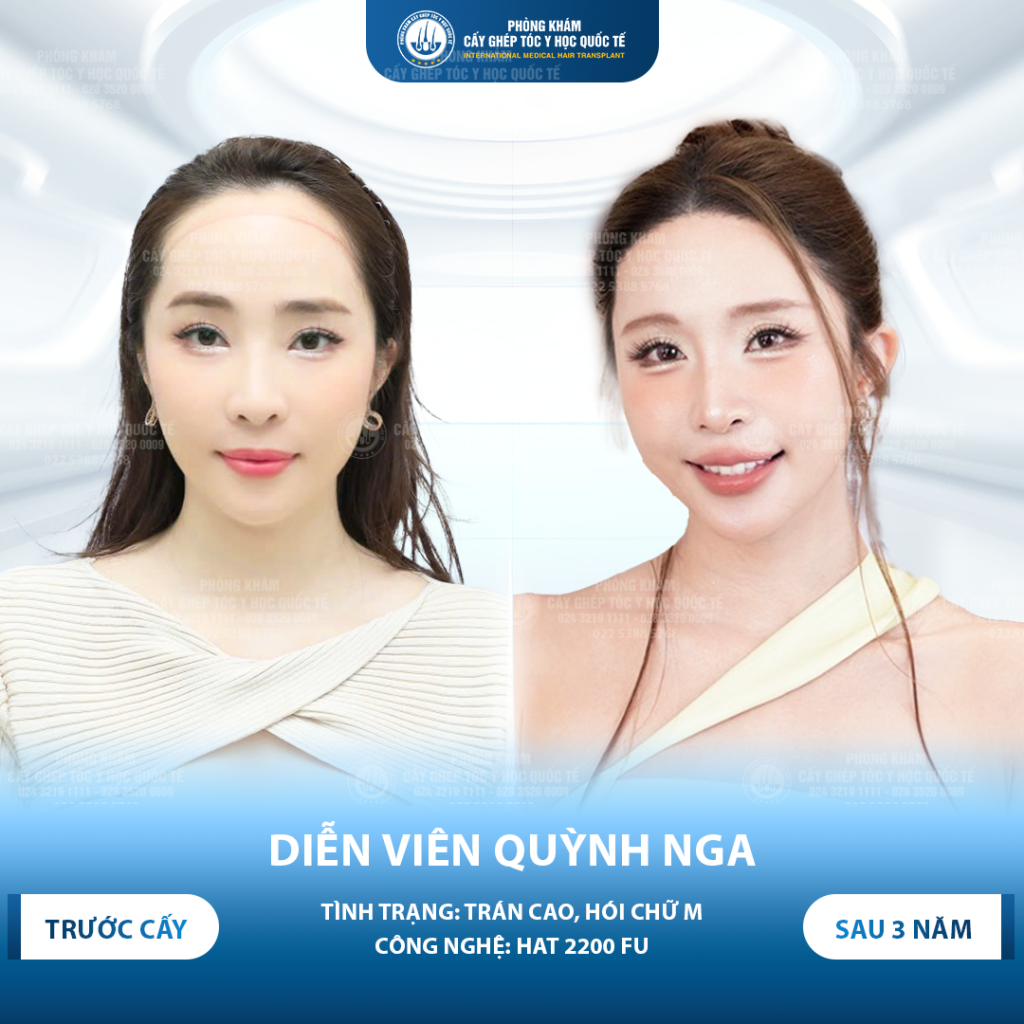 diễn viên quỳnh nga sau 3 năm cấy tóc