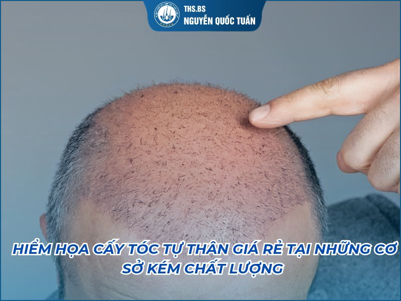 hiểm quả cấy tóc giá rẻ