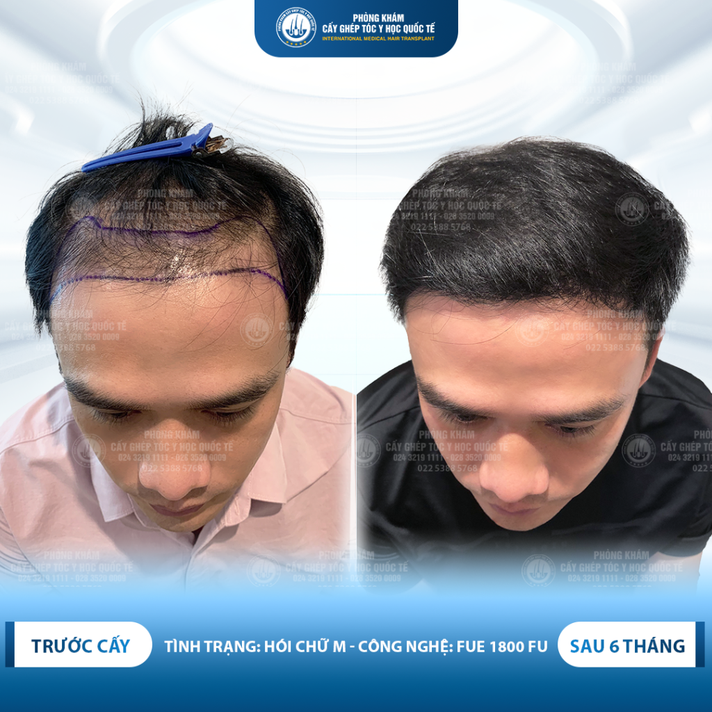 hiệu quả cấy tóc hói chữu m 