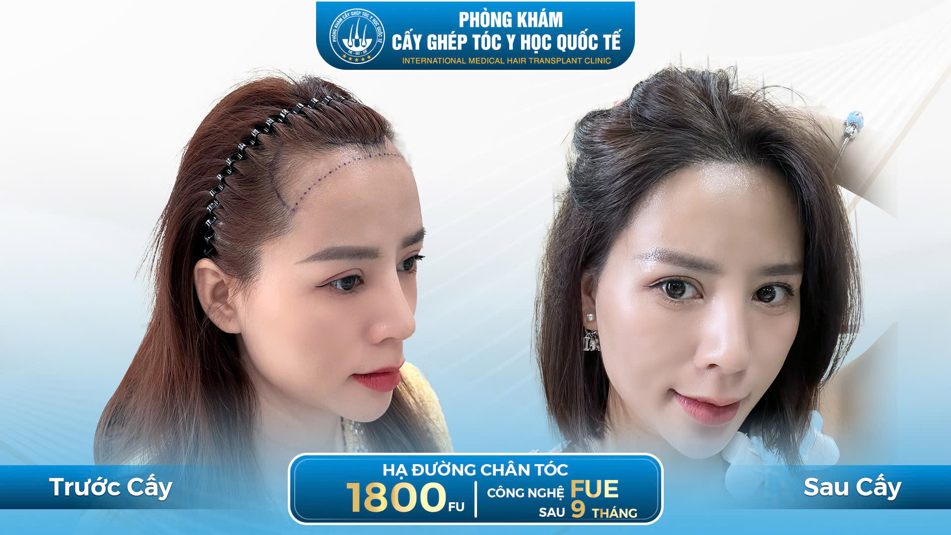 hiệu quả cấy tóc tự thâ 