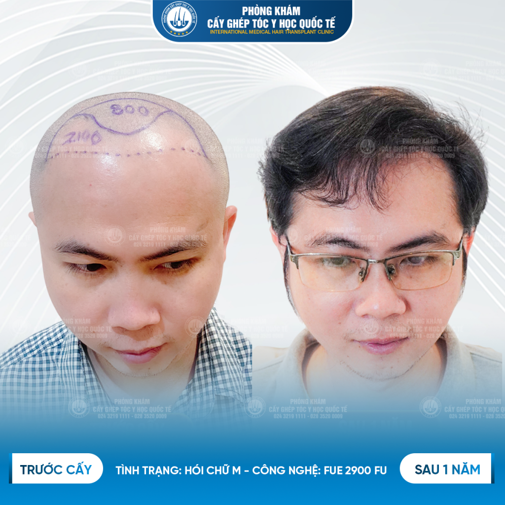 kết quả sau cấy 