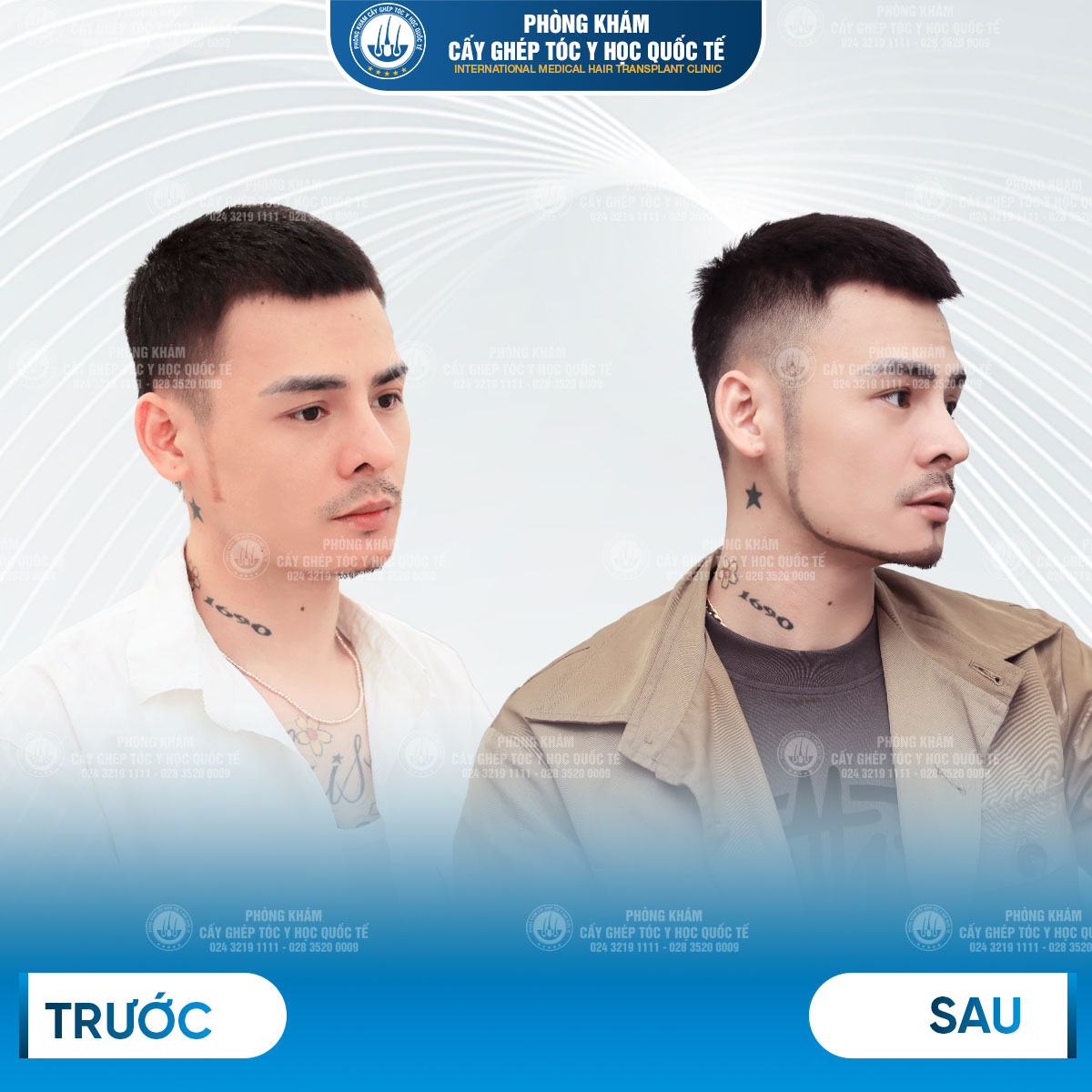 hoa vinh cấy râu 