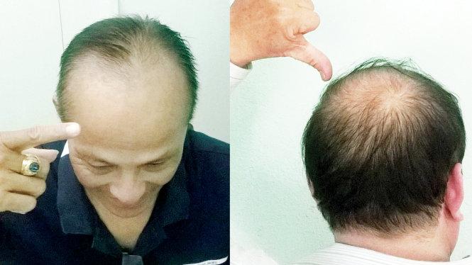 hói đầu do bệnh lí 