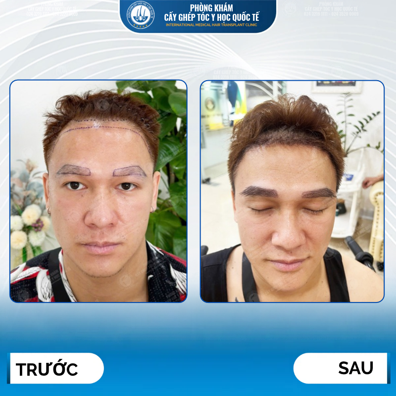 kết quả cấy lông mày nam giới 