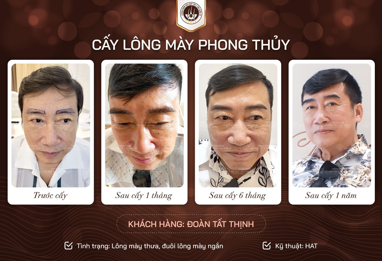 kết quả cấy lông mày
