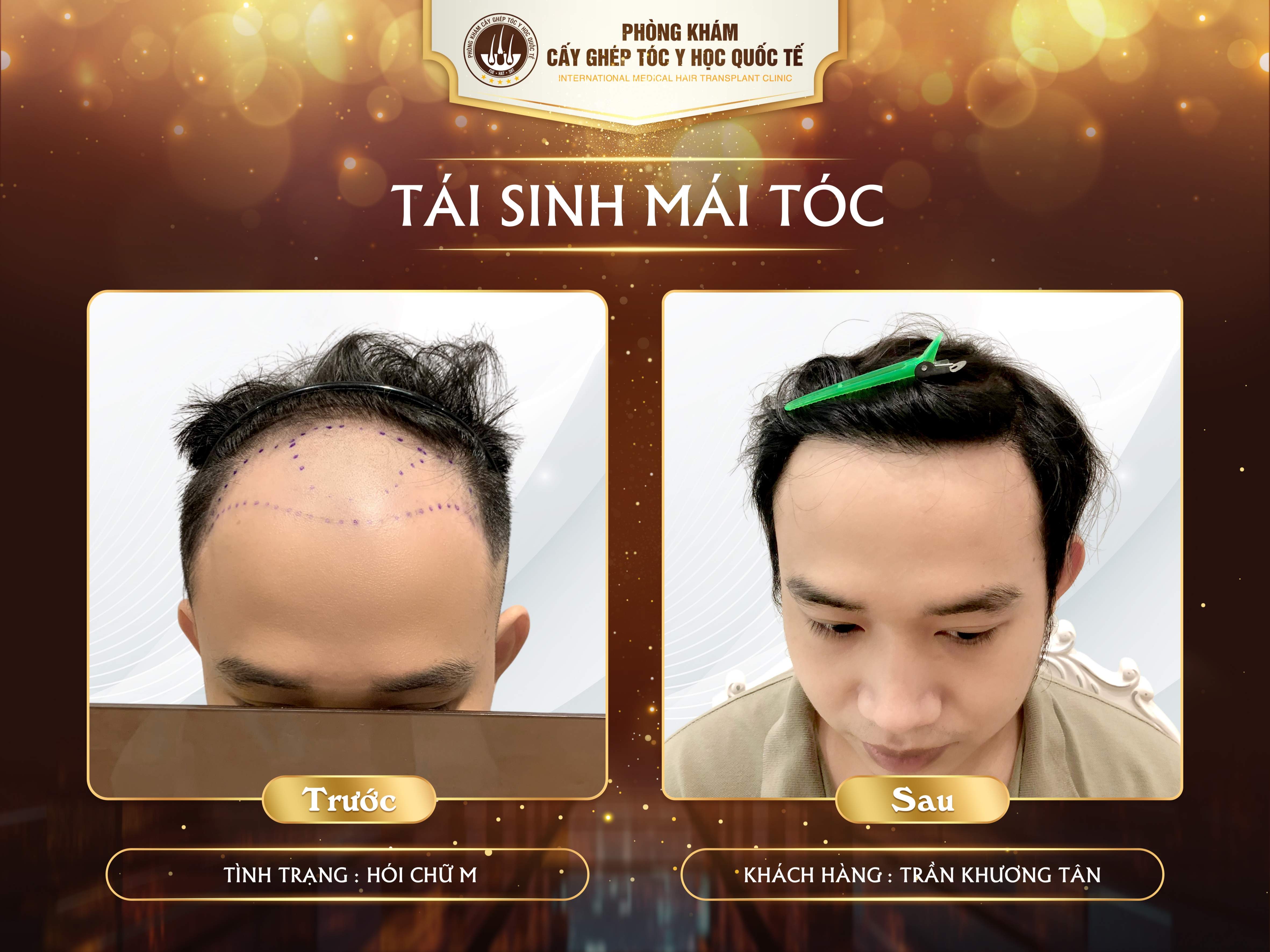 kết quả cấy tóc tại viện cấy tóc y học quôc tế 