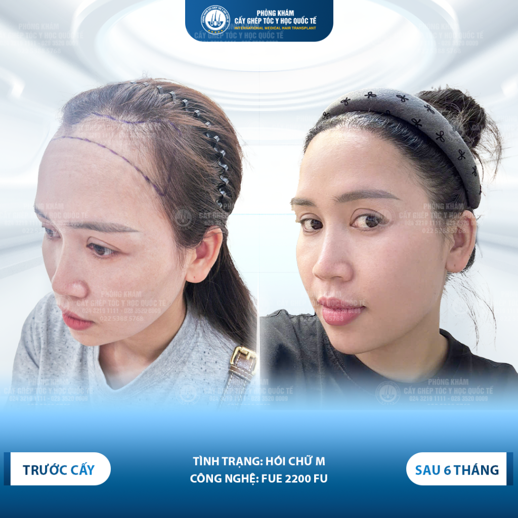 kết quả cấy tóc tự thân