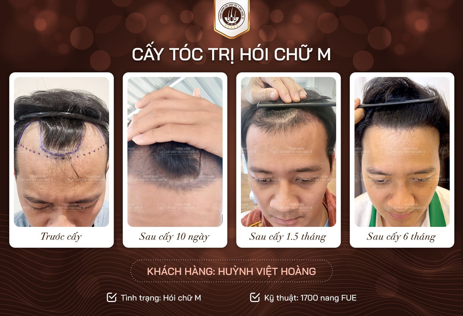 kết quả cấy tóc chữa hói 