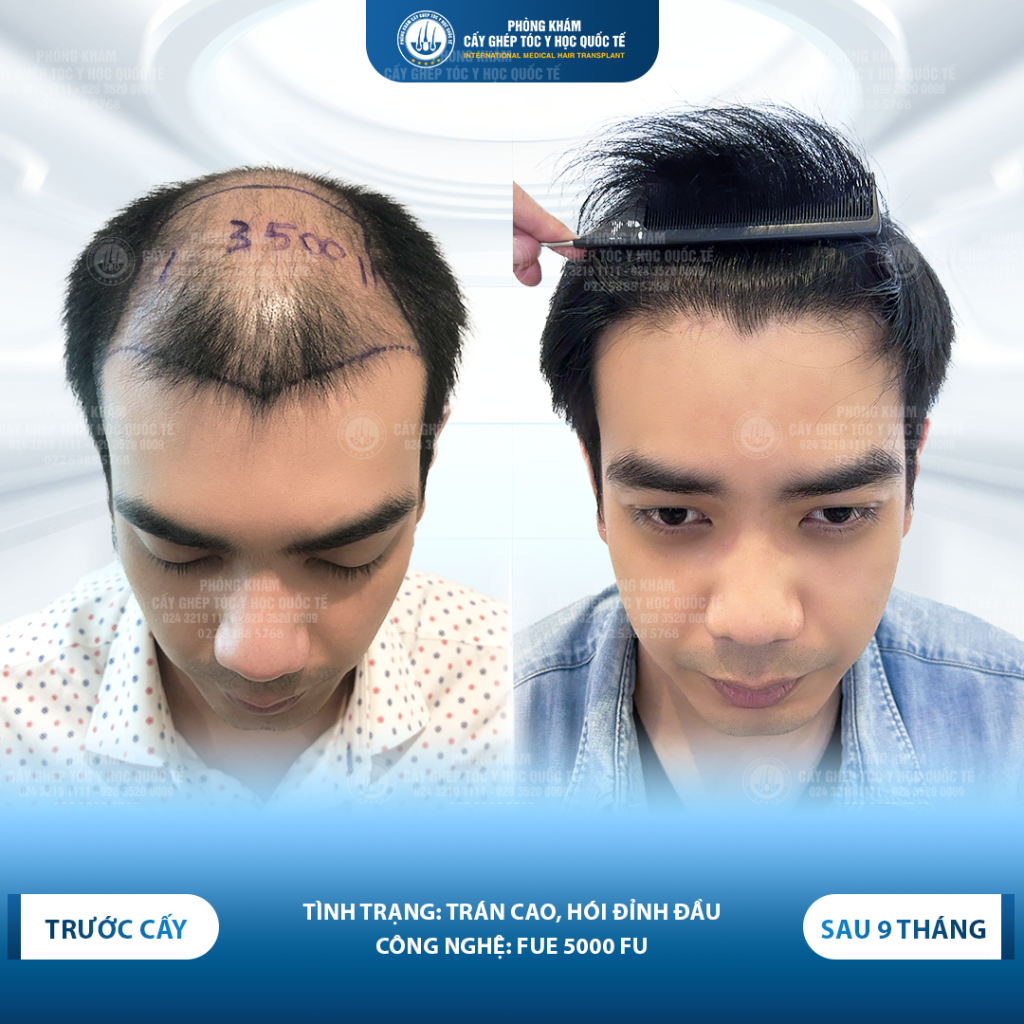 kết quả sau cấy 