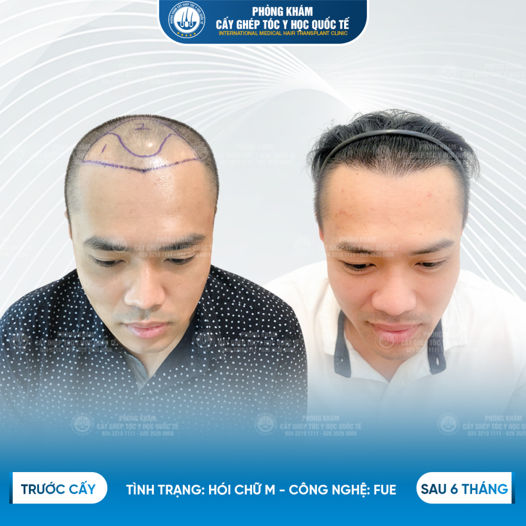 kết quả sau cấy tóc 