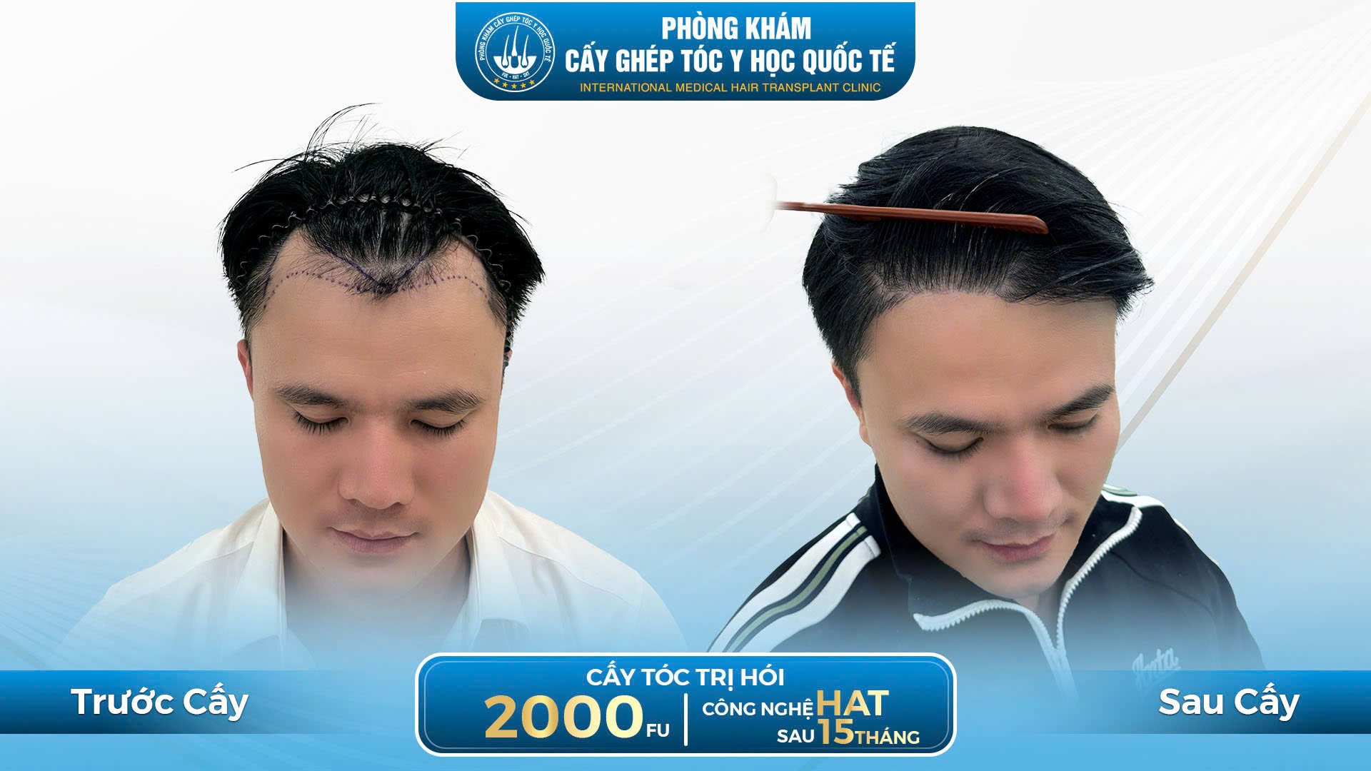 kết quả cấy tóc tại phòng khám cấy ghép tóc y học quốc tế 