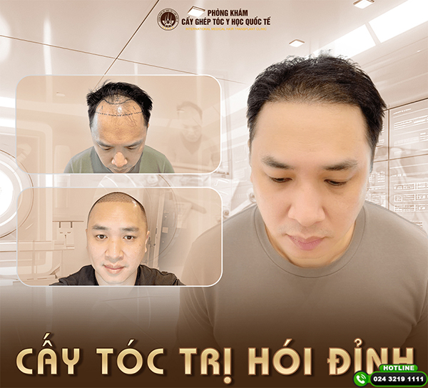 khách hàng được bác sĩ Dương Văn Thọ cấy ghép