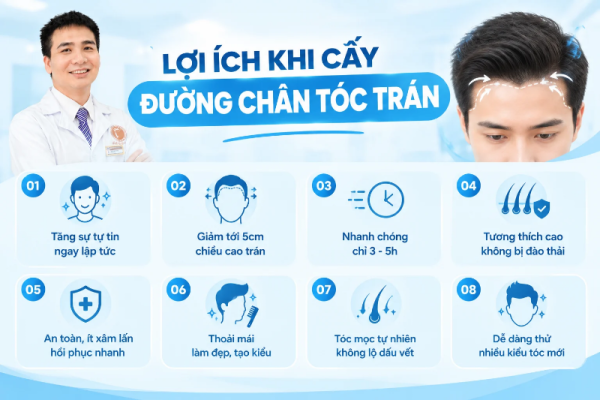 lợi ích khi cấy đường chân tóc trán