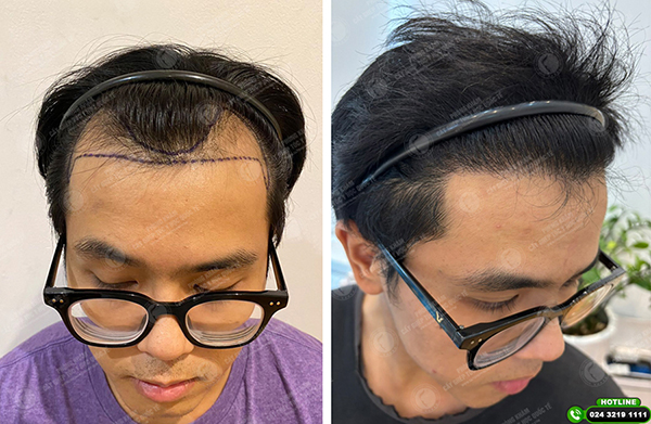 khách hàng được bác sĩ Dương Văn Thọ cấy ghép