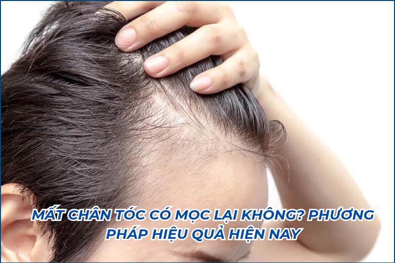 mất chân tóc có mọc lại không