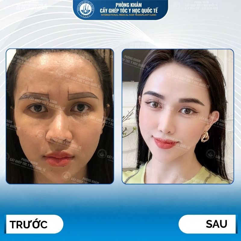 hiệu quả sau khi cấy lông mày tại trung tâm cấy tóc y học quốc tế