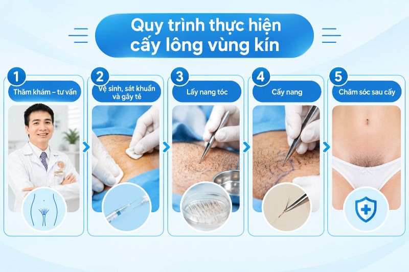 quy trình thực hiện cấy lông vùng kín 