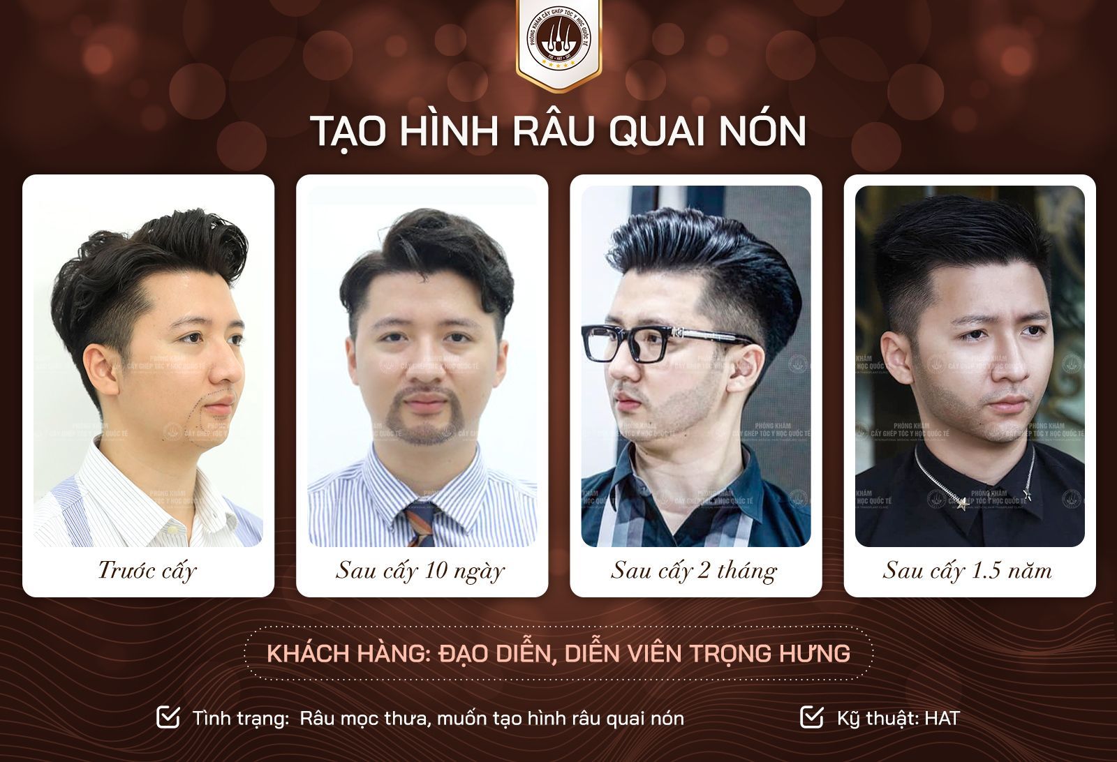 trọng hưng cấy râu